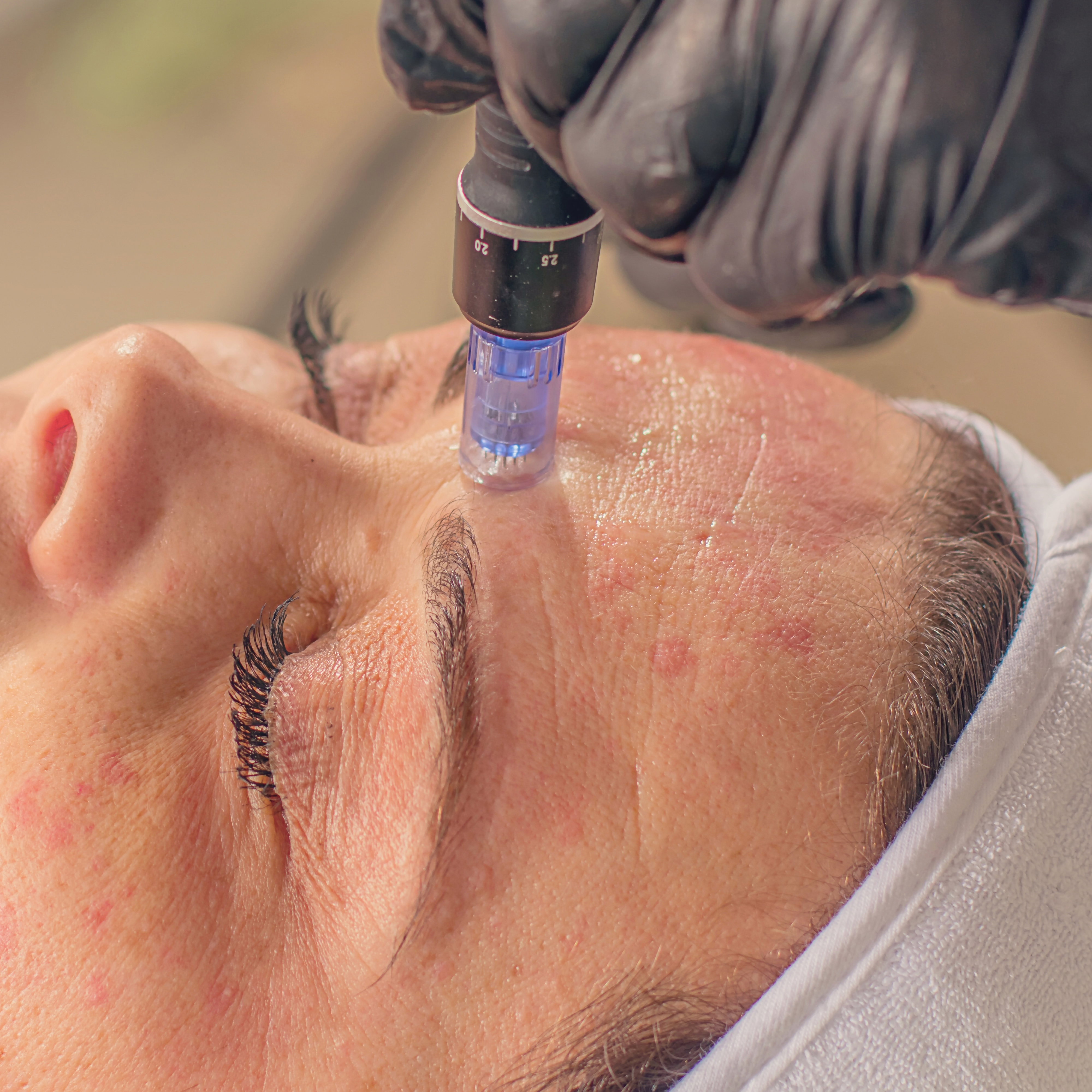 Micro-needle example image