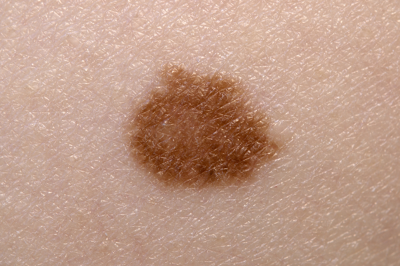 Closeup of a Melanoma