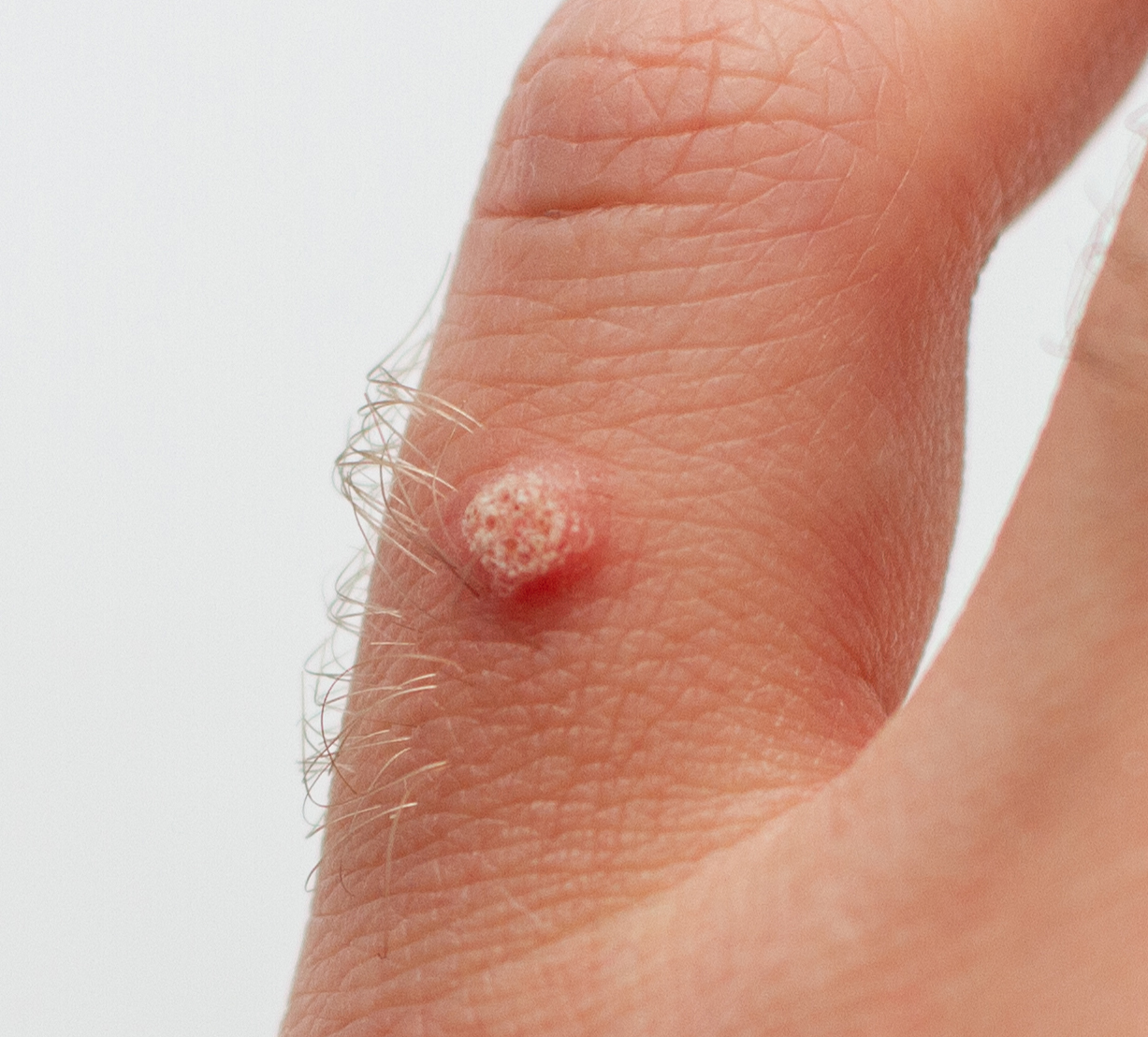 Wart on a finger