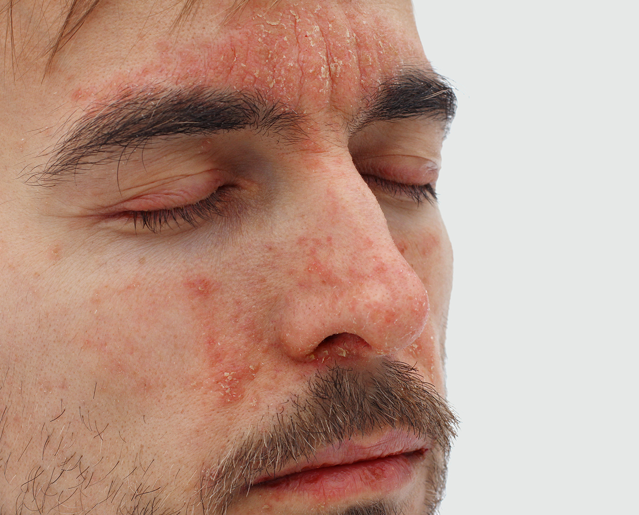 Closeup of a rash on a man's face