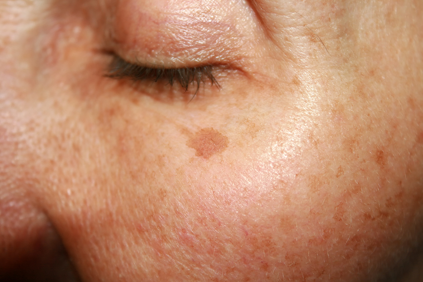 Melasma
