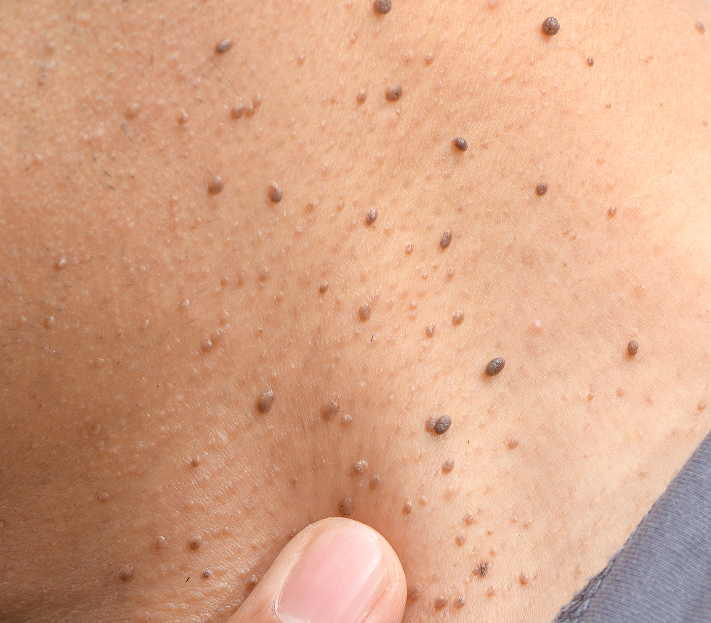 Skin Tags