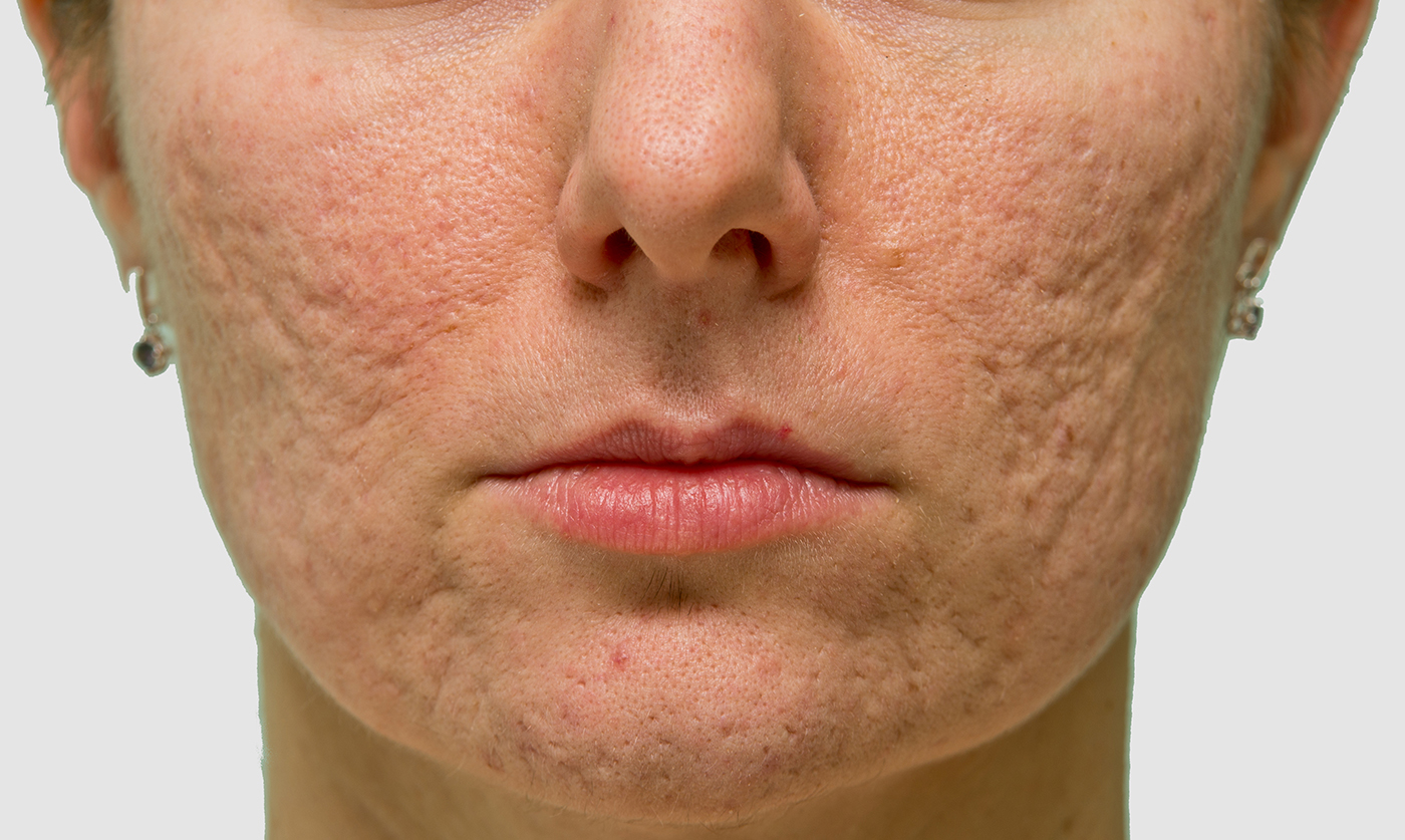 Acne scars