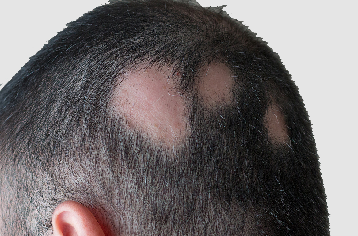 Hair Loss - Alopecia