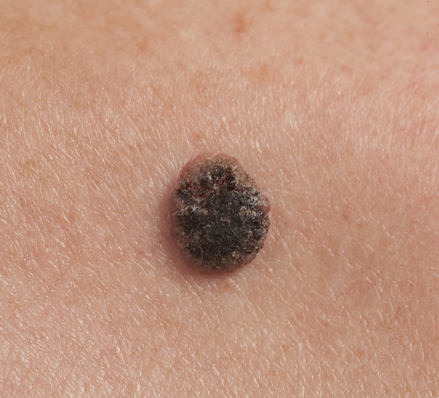 Skin Cancer