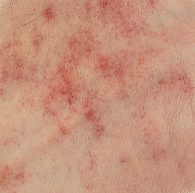 Skin Rash