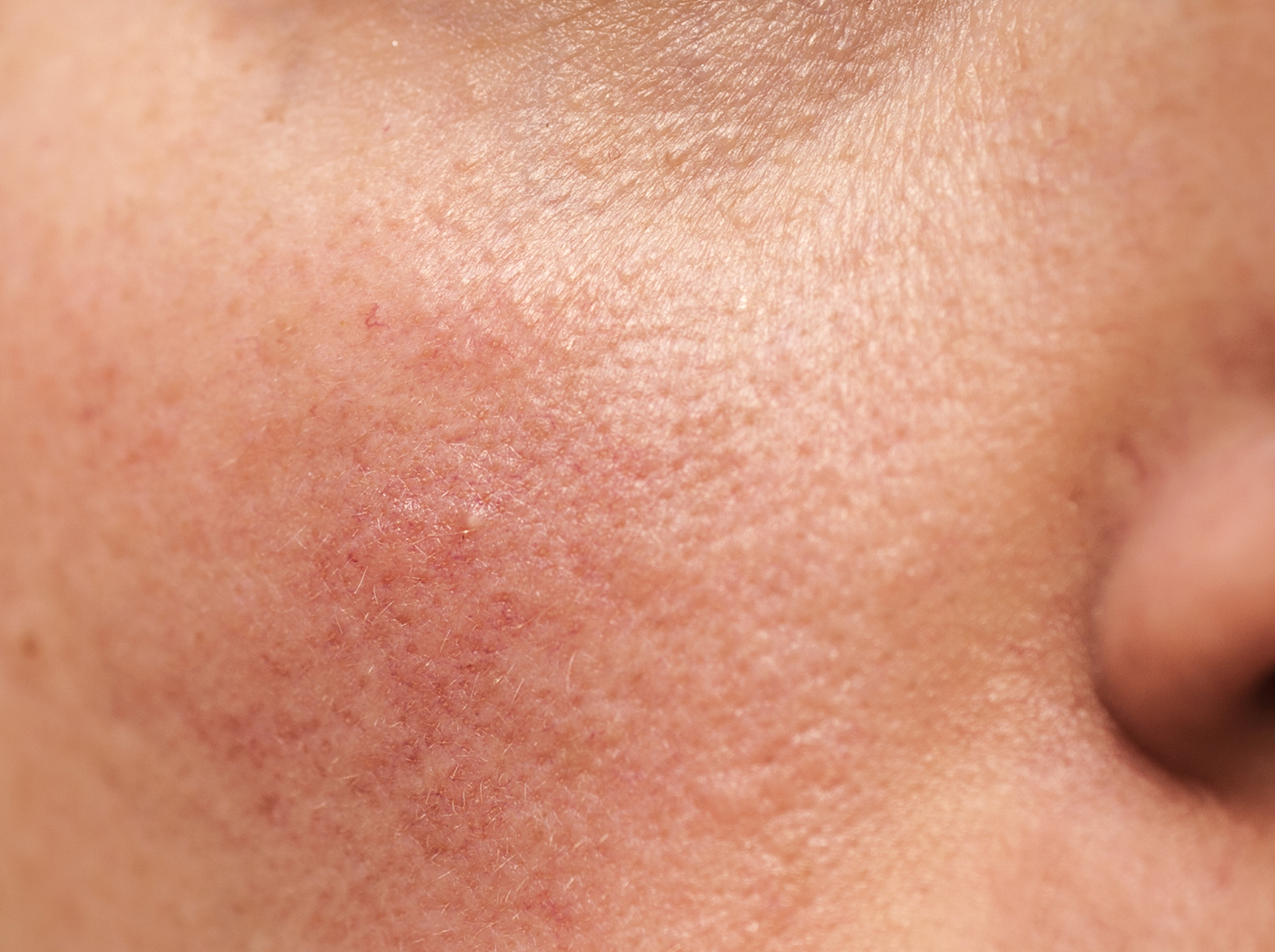 Closeup of a rash on a person's face