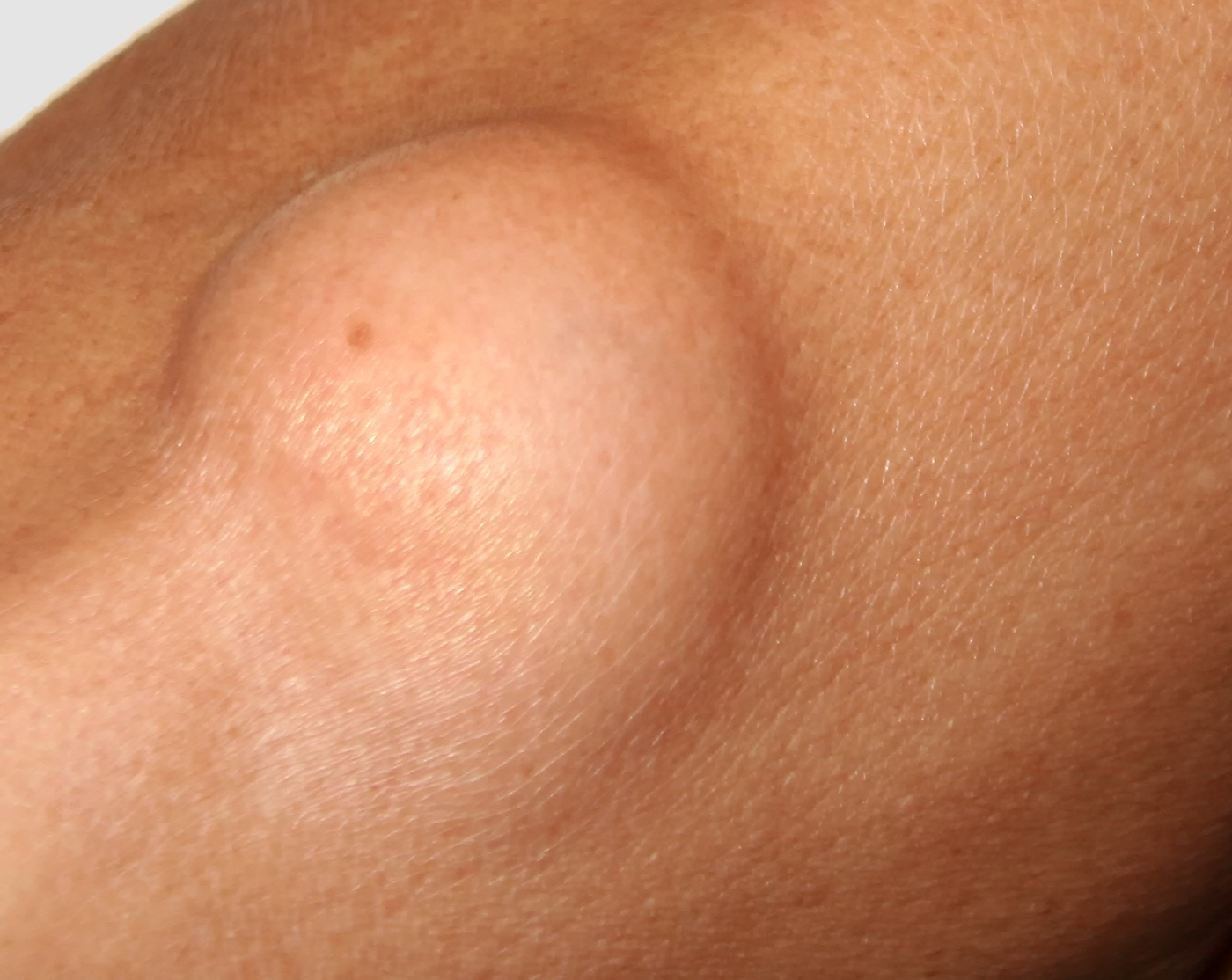 Lipoma