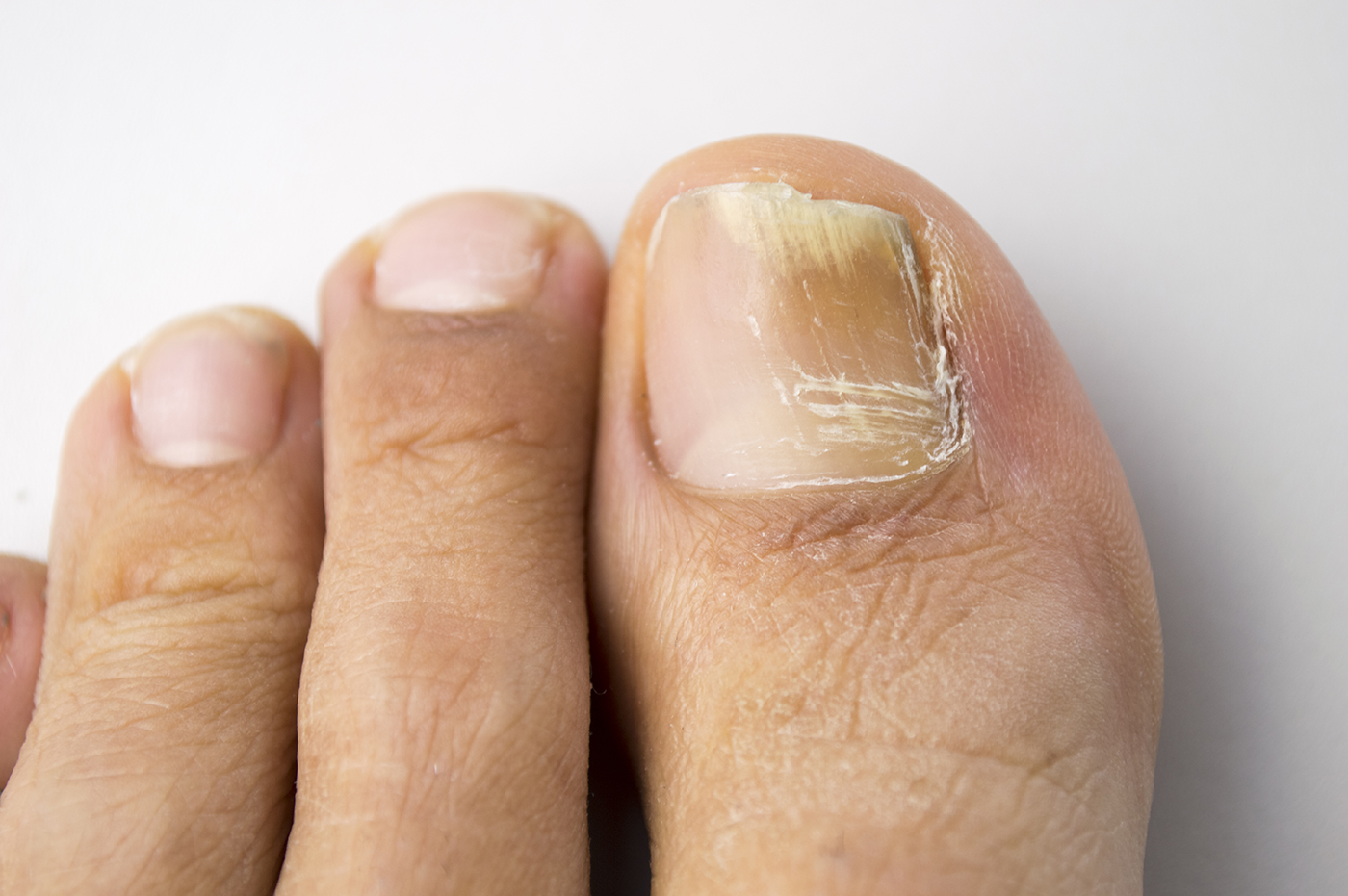 Toe fungus