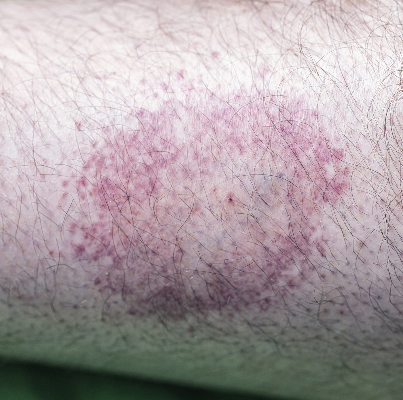 Circular bullseye rash on the arm