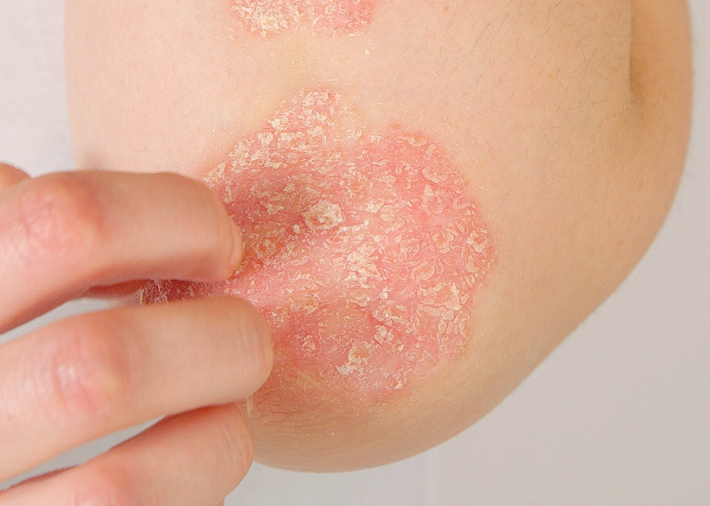 Psoriasis rash on elbow