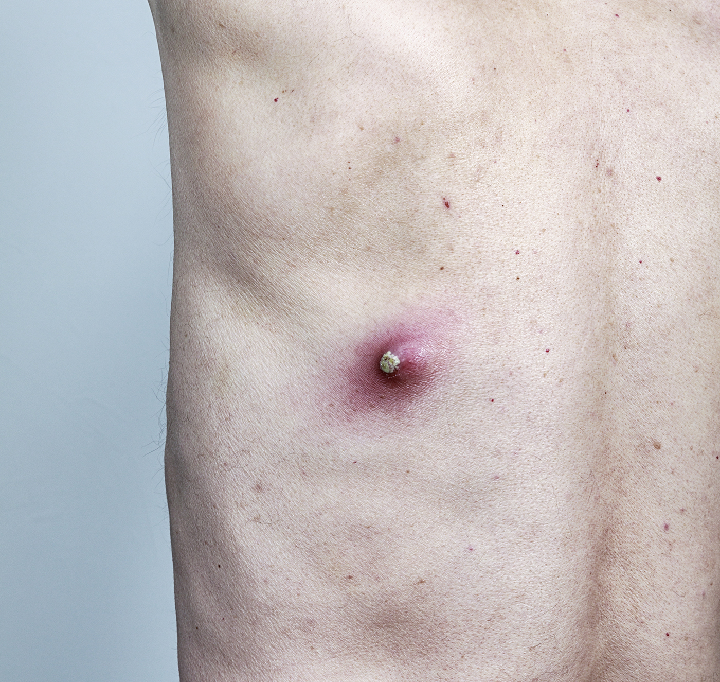 A cyst on a man's back