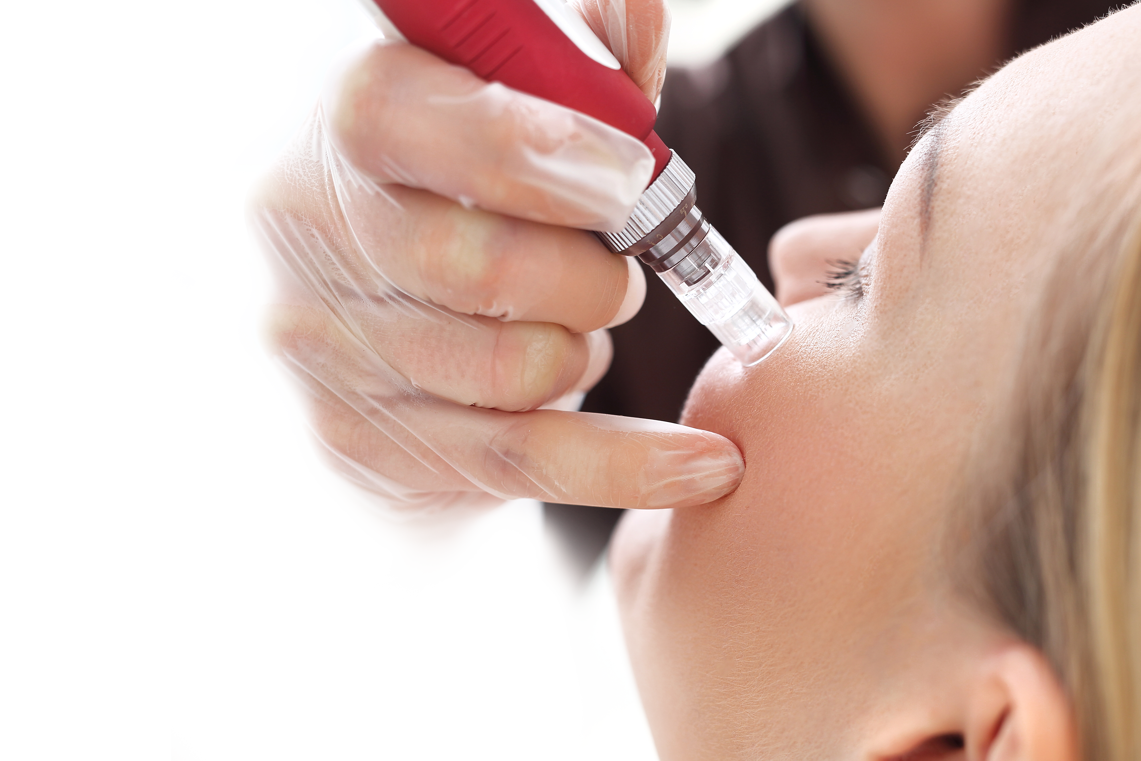 Micro-needling