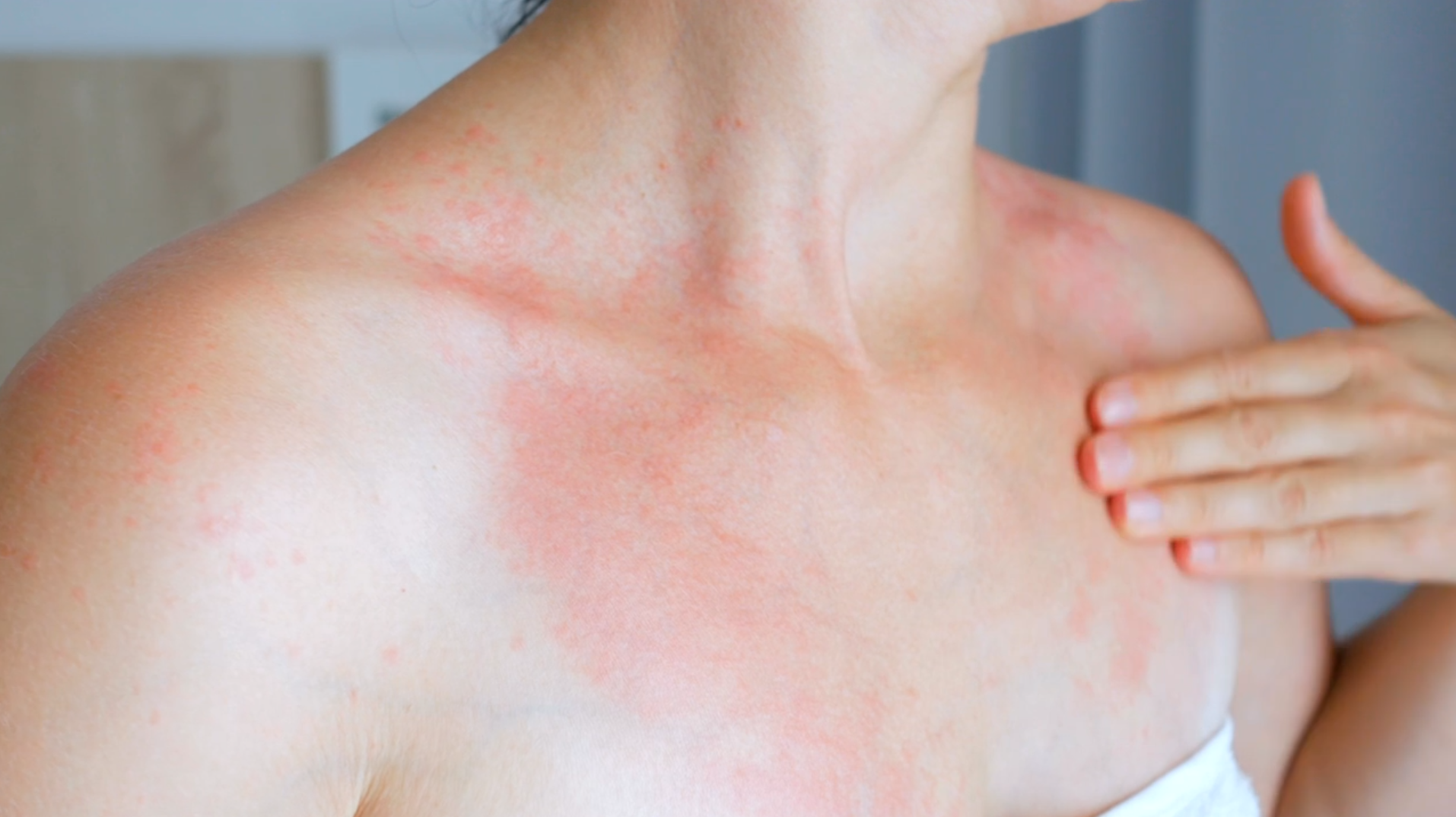 Rashes