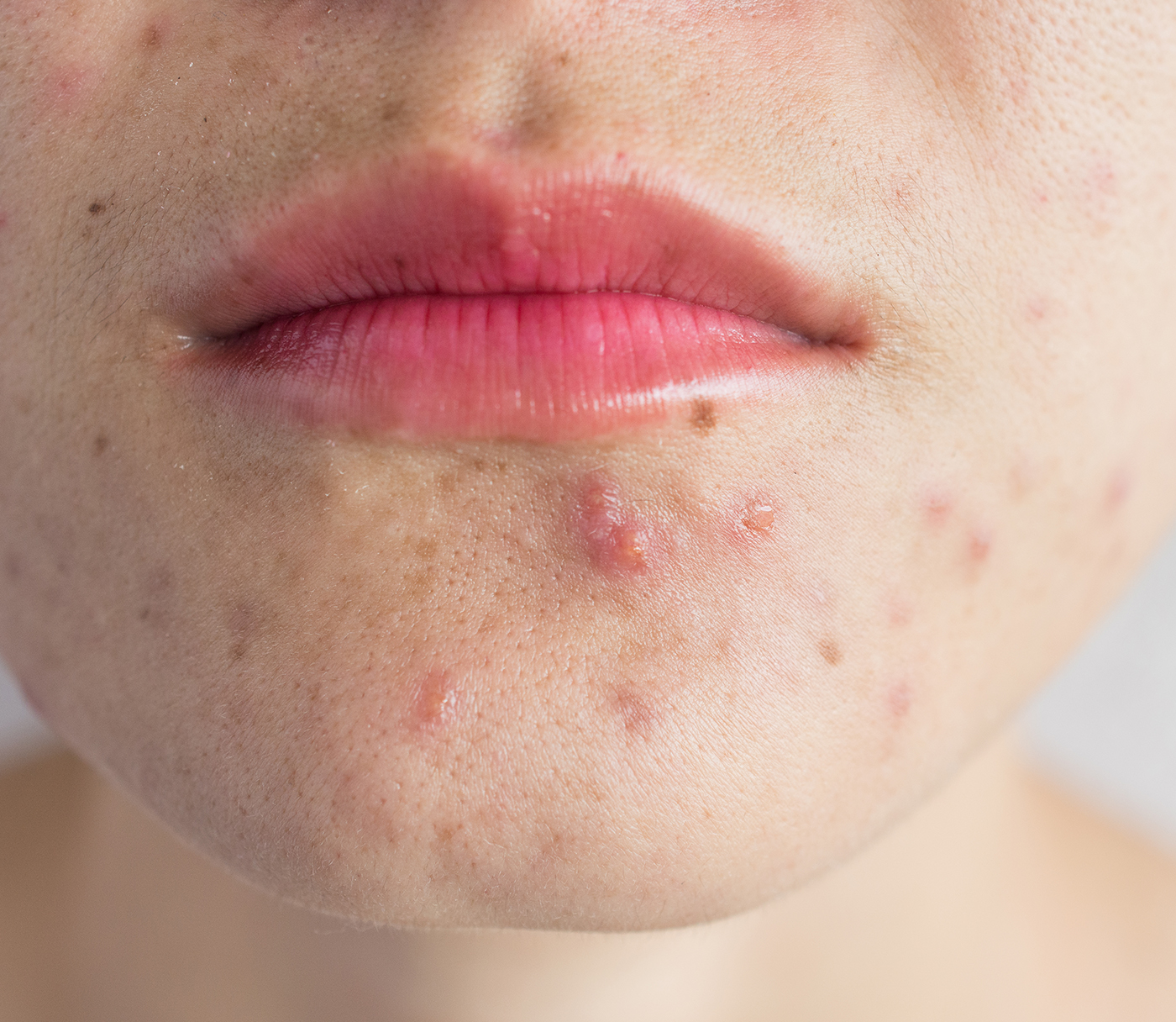 Acne on the chin