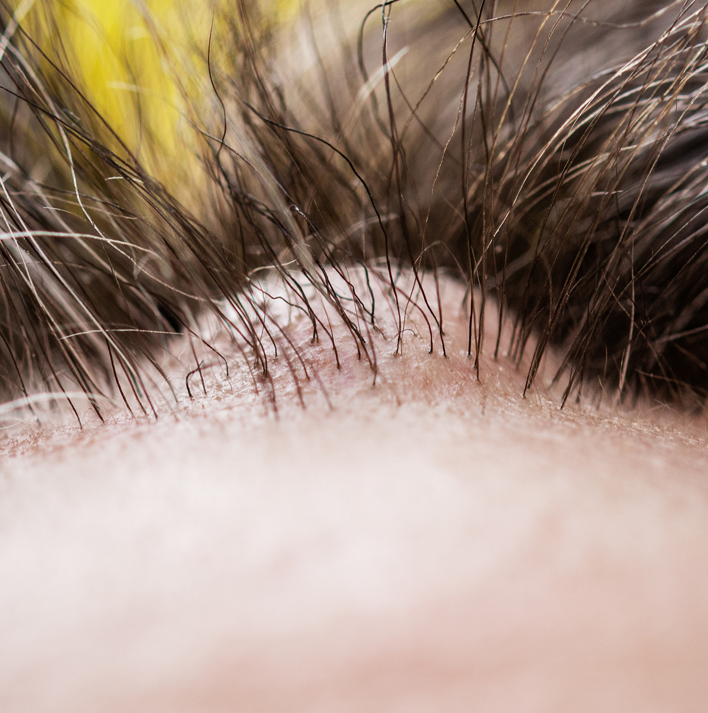 Scalp Lipoma