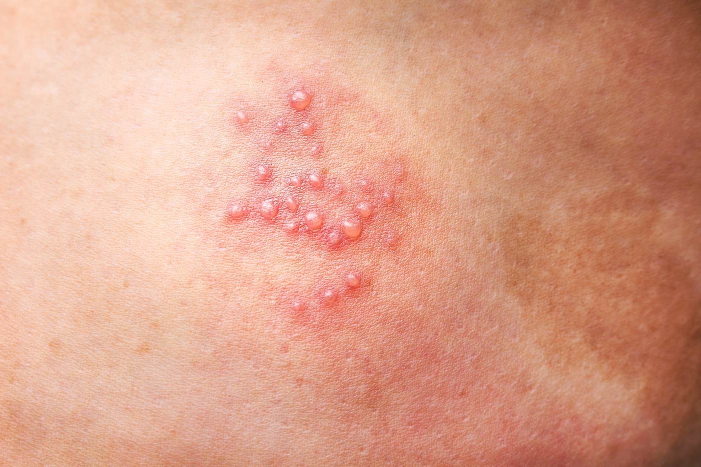 Herpes