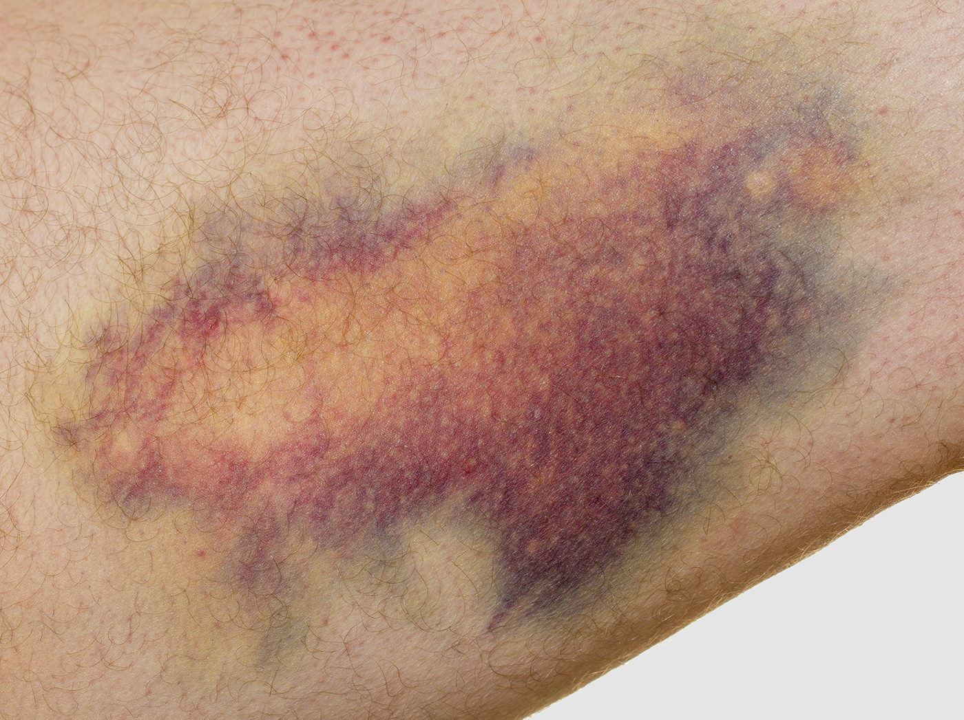 Purpura