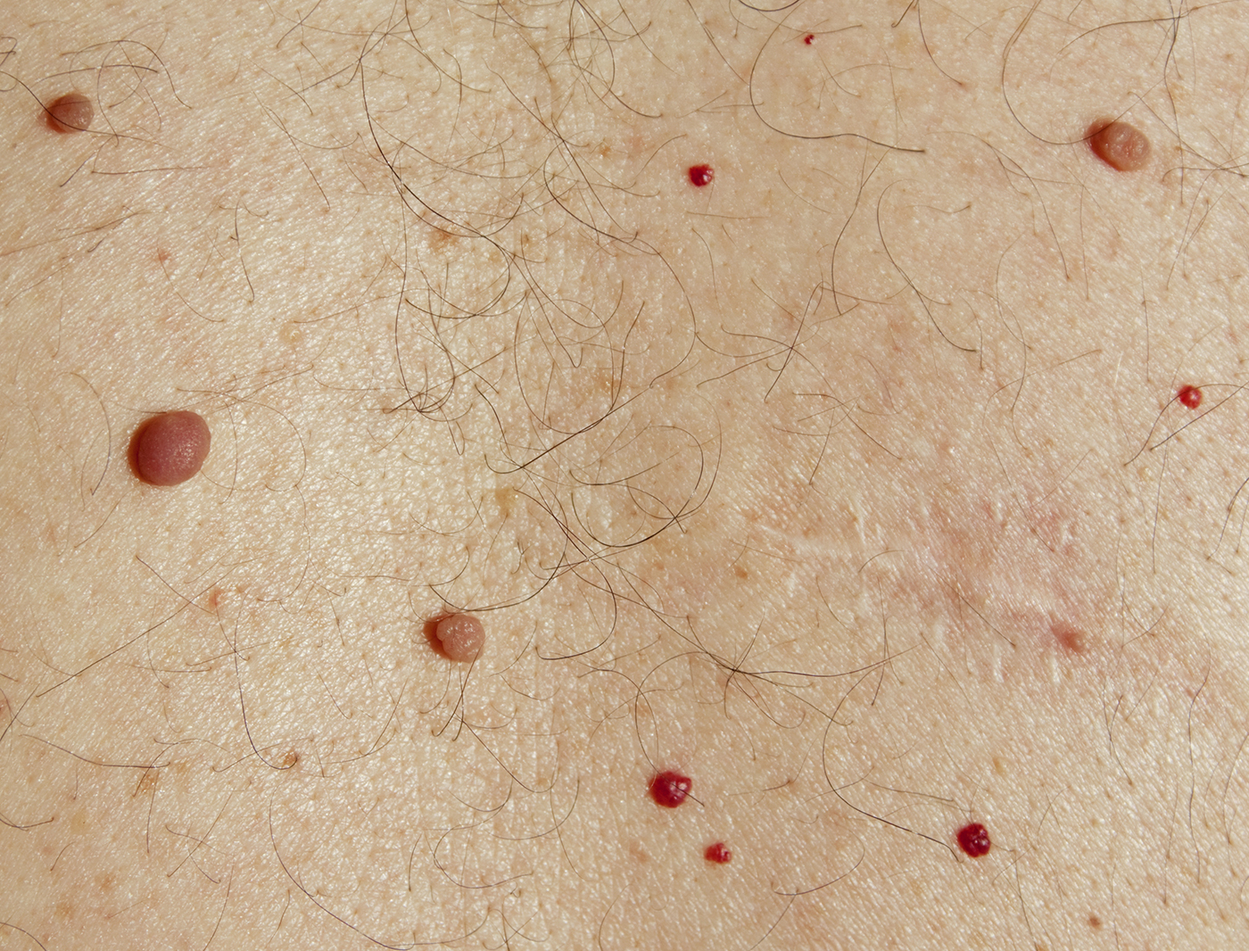 Angioma