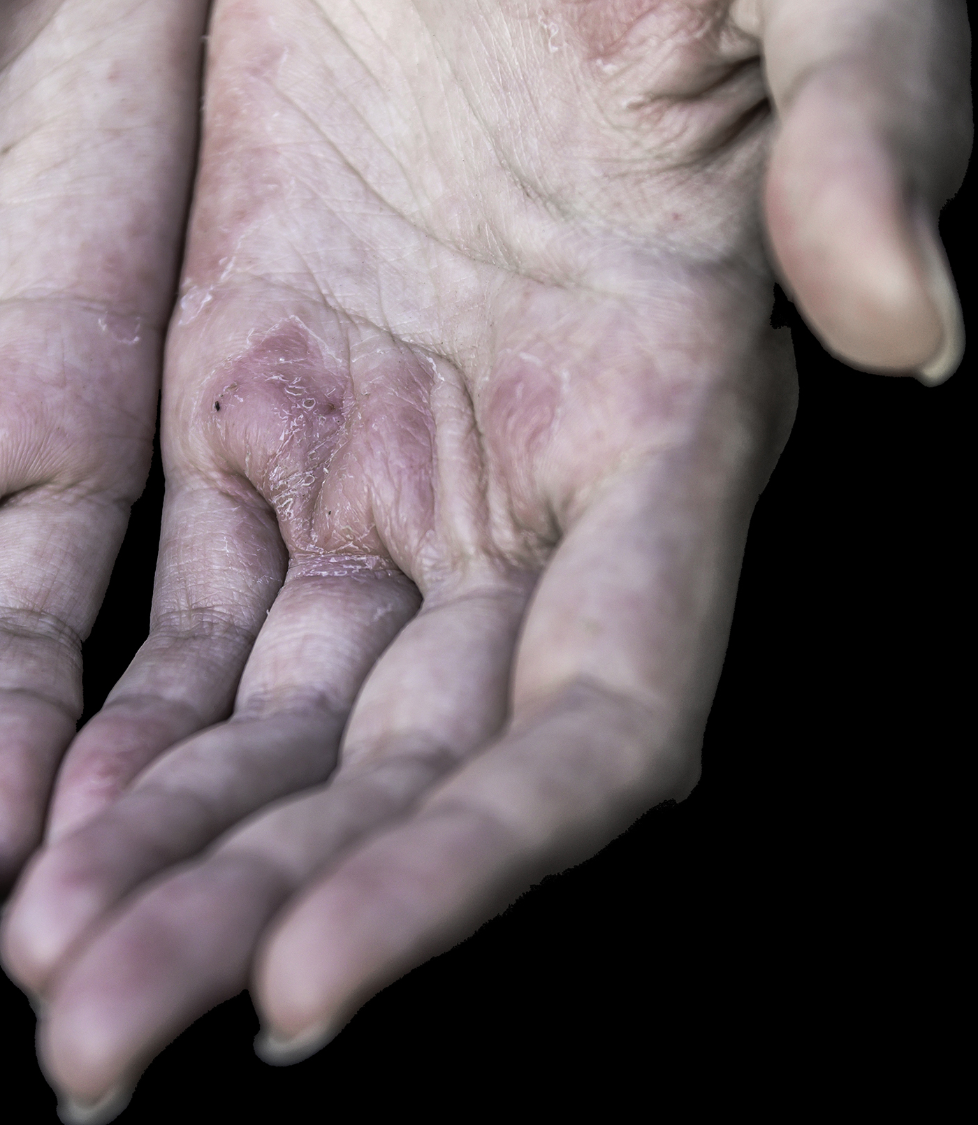 Psoriasis
