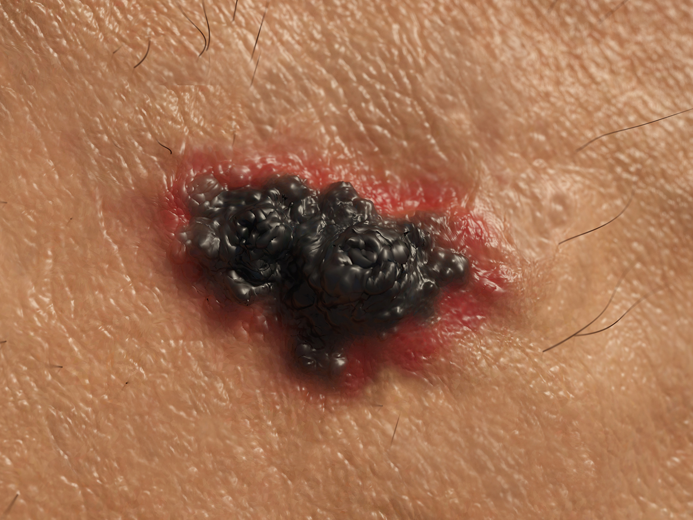 Skin Cancer