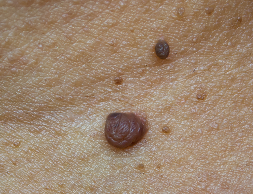 Skin tag